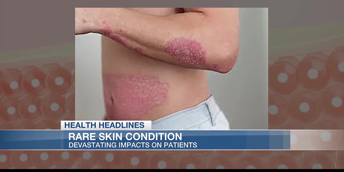 Rare Skin Rash Health Headlines: Rare skin condition that has a devastating impact on ...