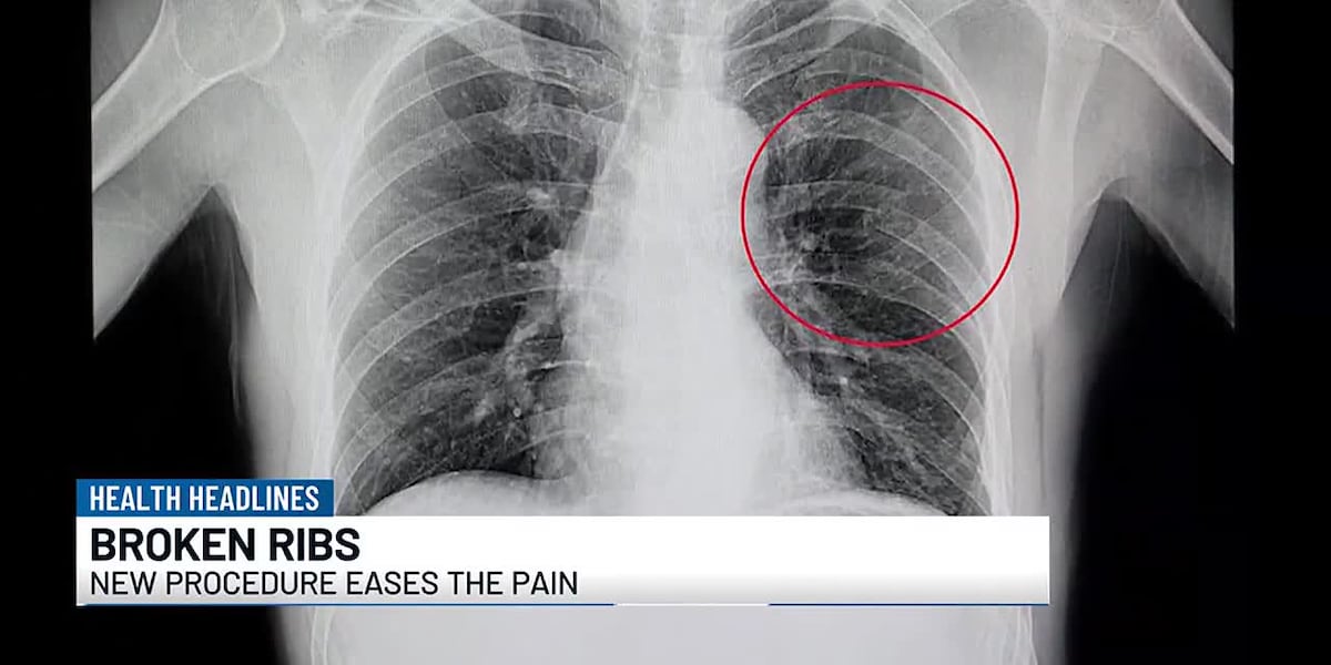 Person With Broken Rib Health Headlines: Easing the pain of broken ribs